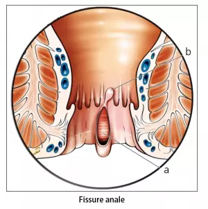 Traitement chirurgicale de la fissure anale