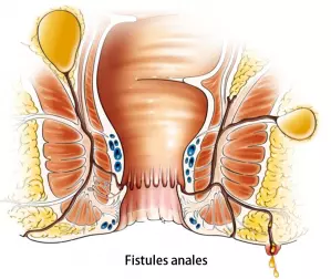 Fistule anale