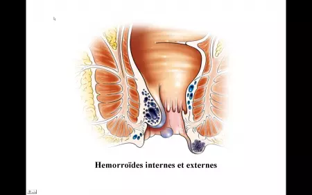 Hémorroidectomie