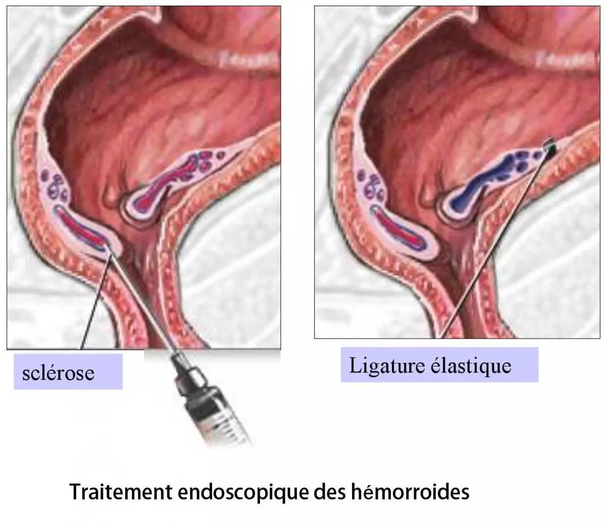 Hémorroidectomie 3