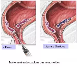 Hémorroidectomie 3
