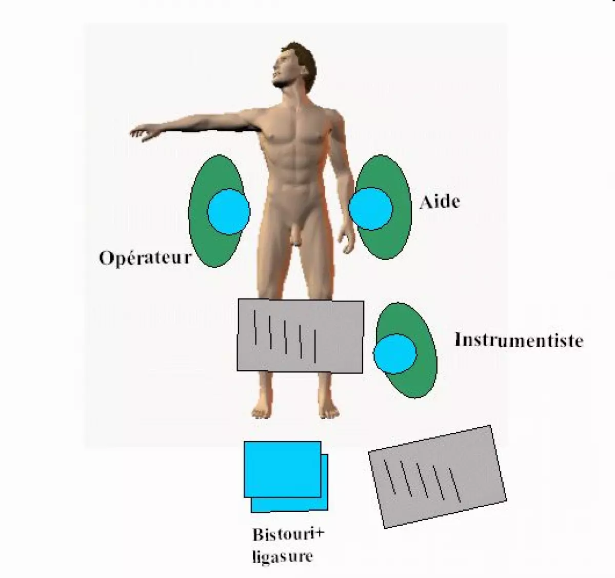 oesophagectomie-03 - IBODE