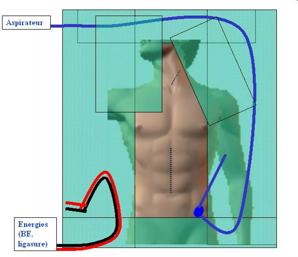 oesophagectomie-04 - IBODE