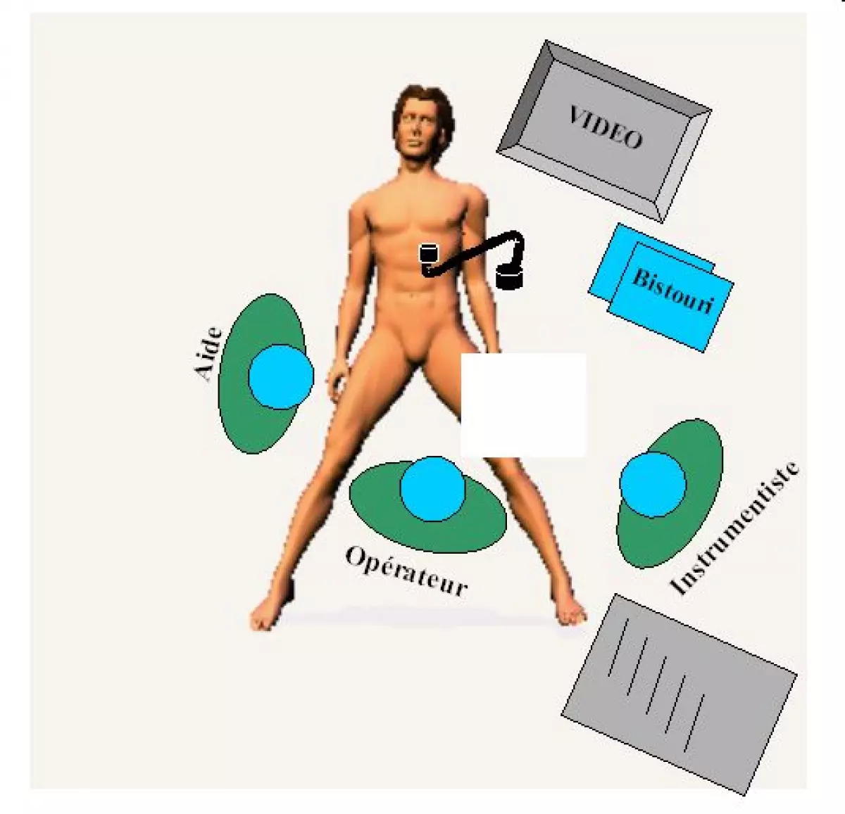 gastrectomie_partielle-03 - IBODE
