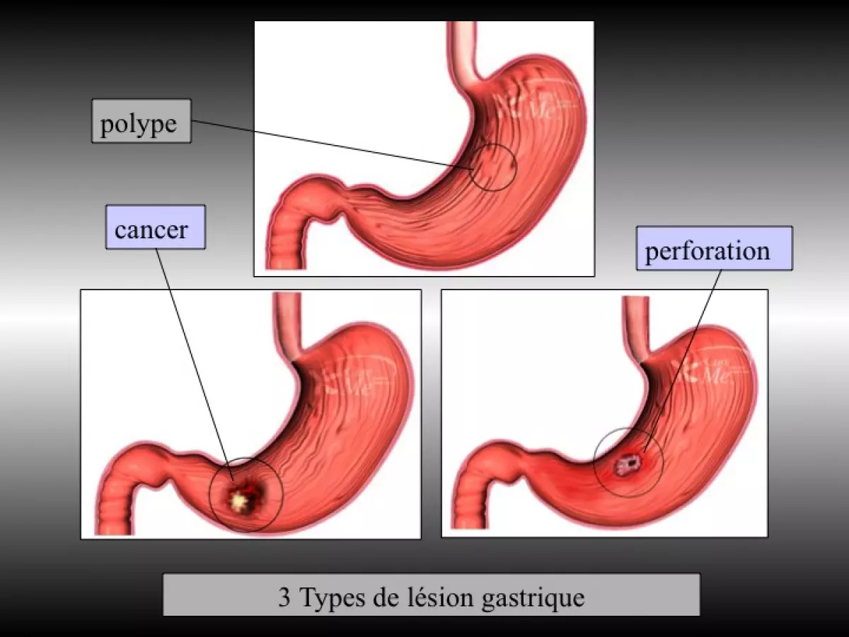 Gastrectomie partielle