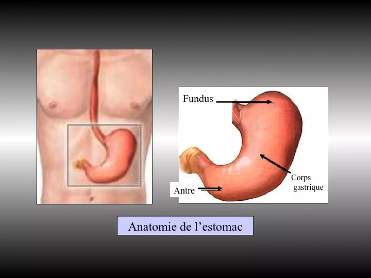 Gastrectomie totale