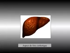 Radiofréquence hépatique sous coelioscopie