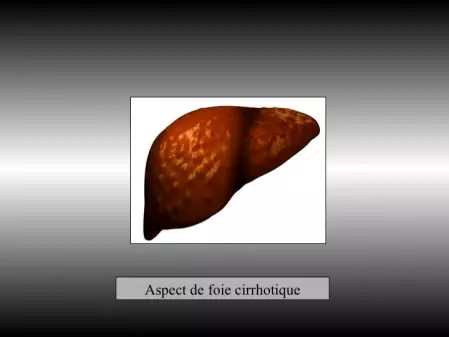 Radiofréquence hépatique sous coelioscopie