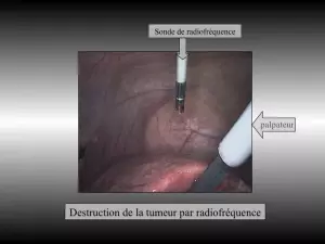 radiofrequence hépatique