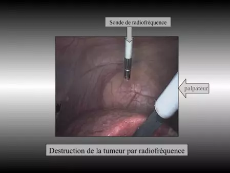 radiofrequence hépatique
