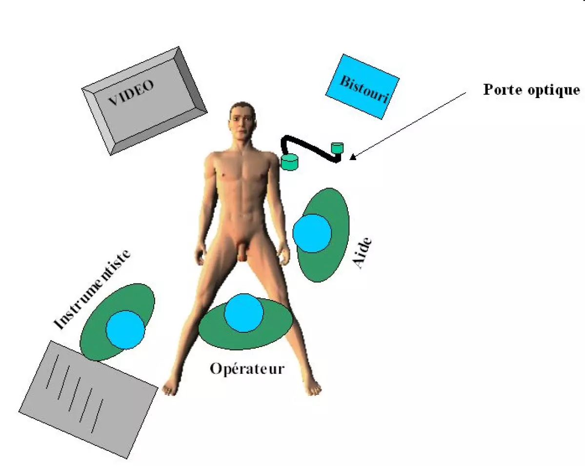 anastomose_choledocoduodenale-03 - IBODE
