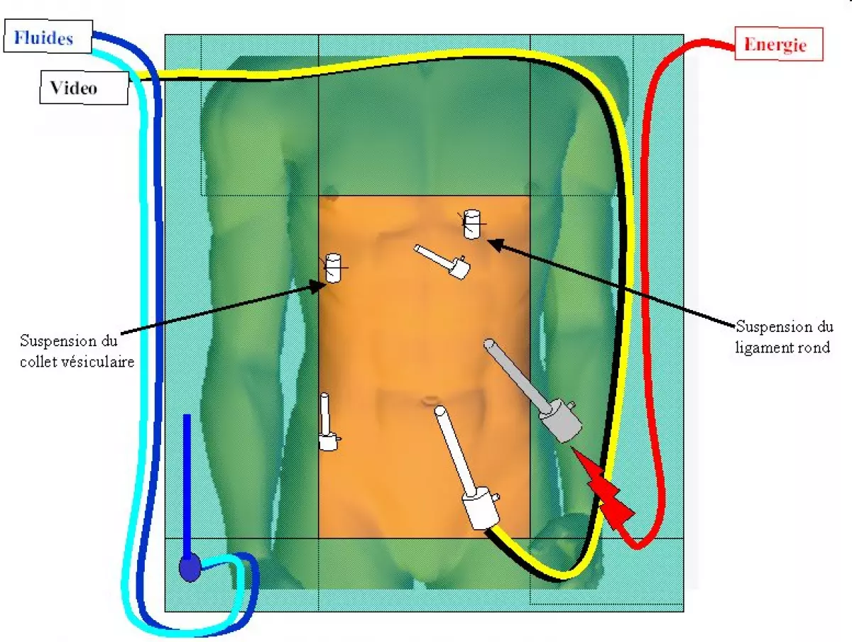 anastomose_choledocoduodenale-04 - IBODE