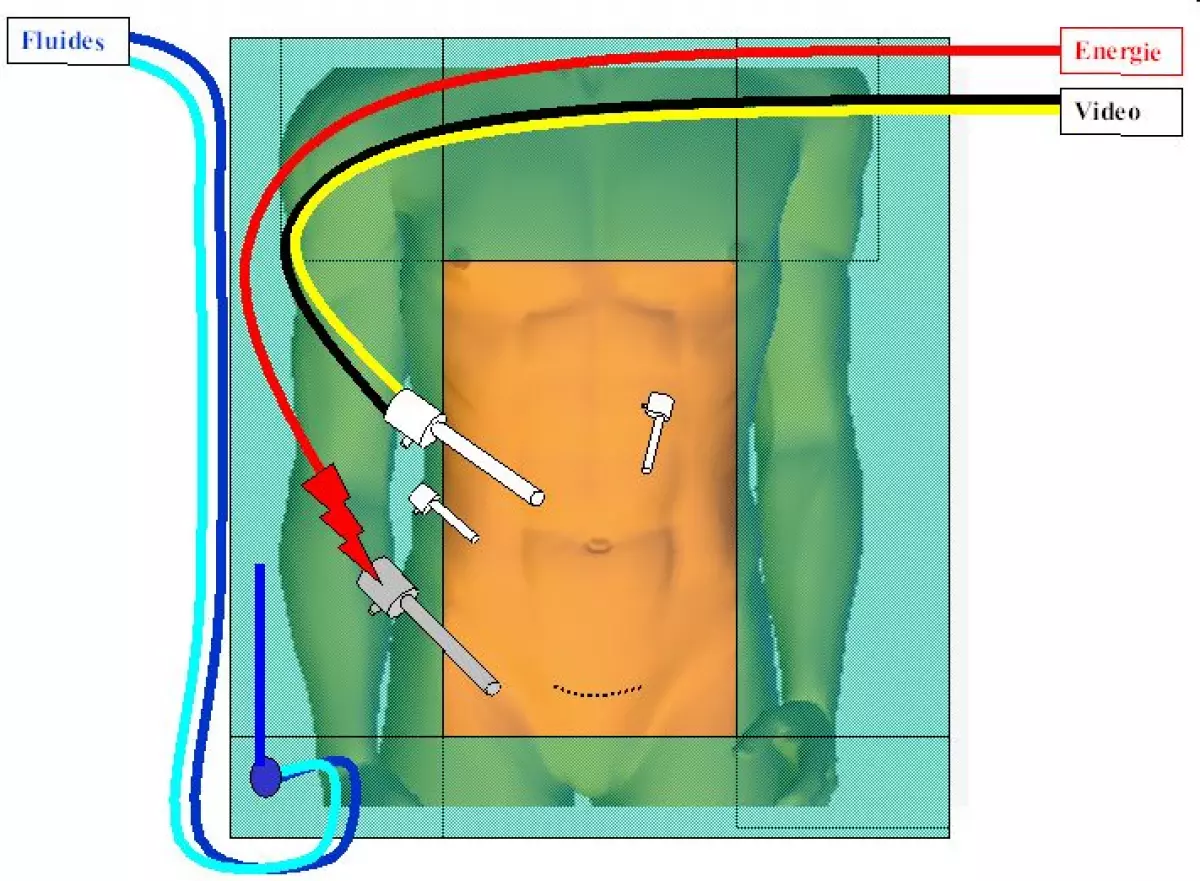 resection_anterieure-04 - IBODE