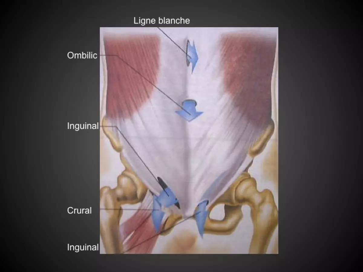 Chirurgie de la paroi