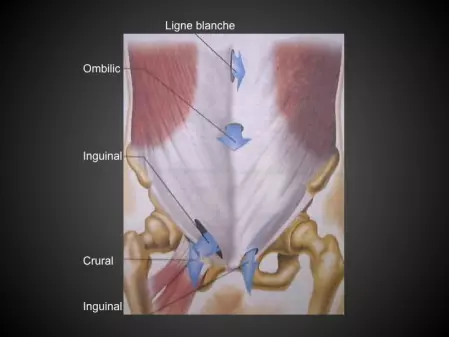 Chirurgie de la paroi