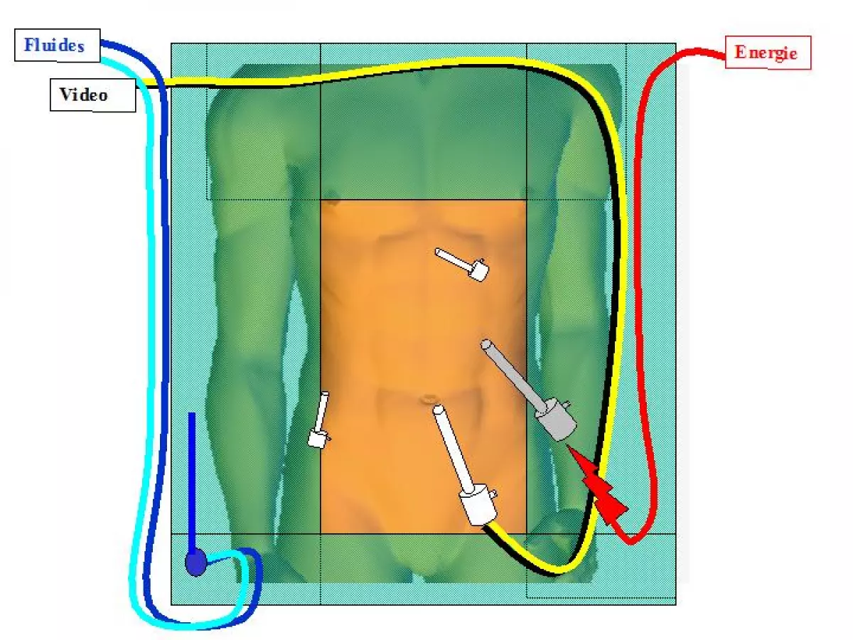 position des trocarts ibode
