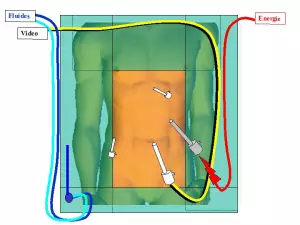 position des trocarts ibode