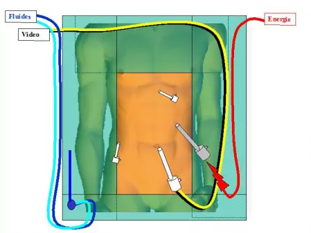 position des trocarts ibode