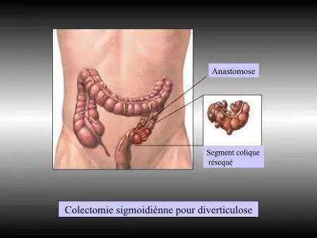 colectomie gauche
