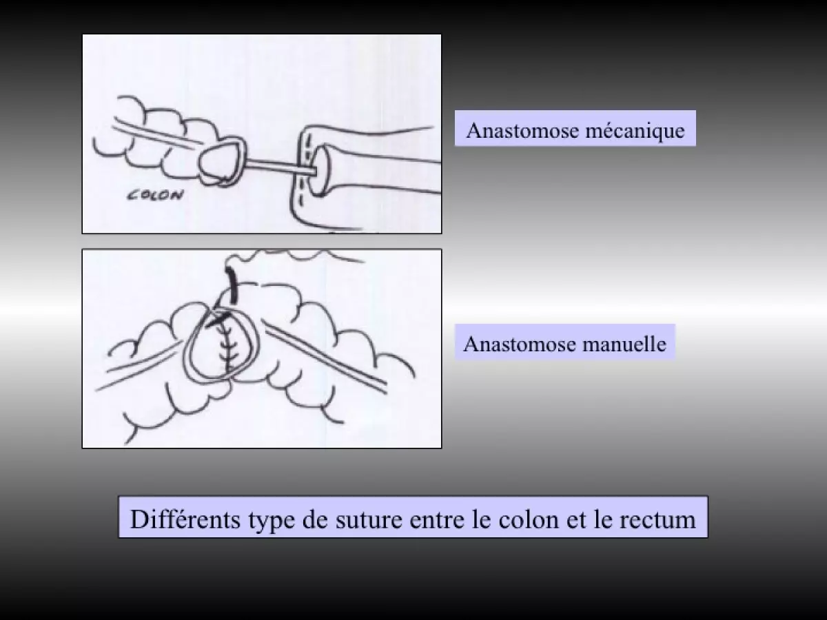 colectomie gauche