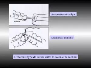 colectomie gauche