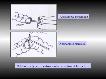 colectomie gauche
