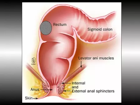 Résection antérieure du rectum