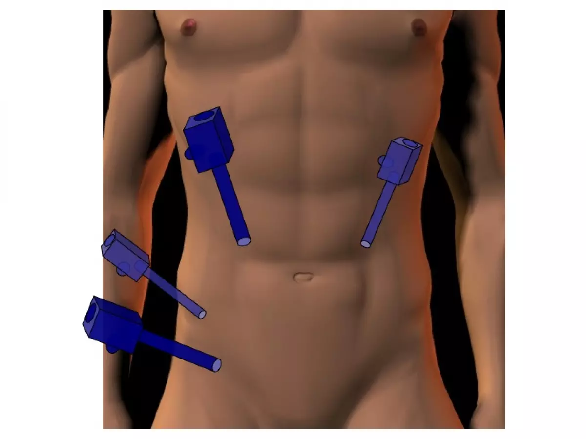 Résection antérieure
