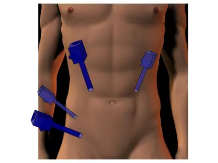 Résection antérieure