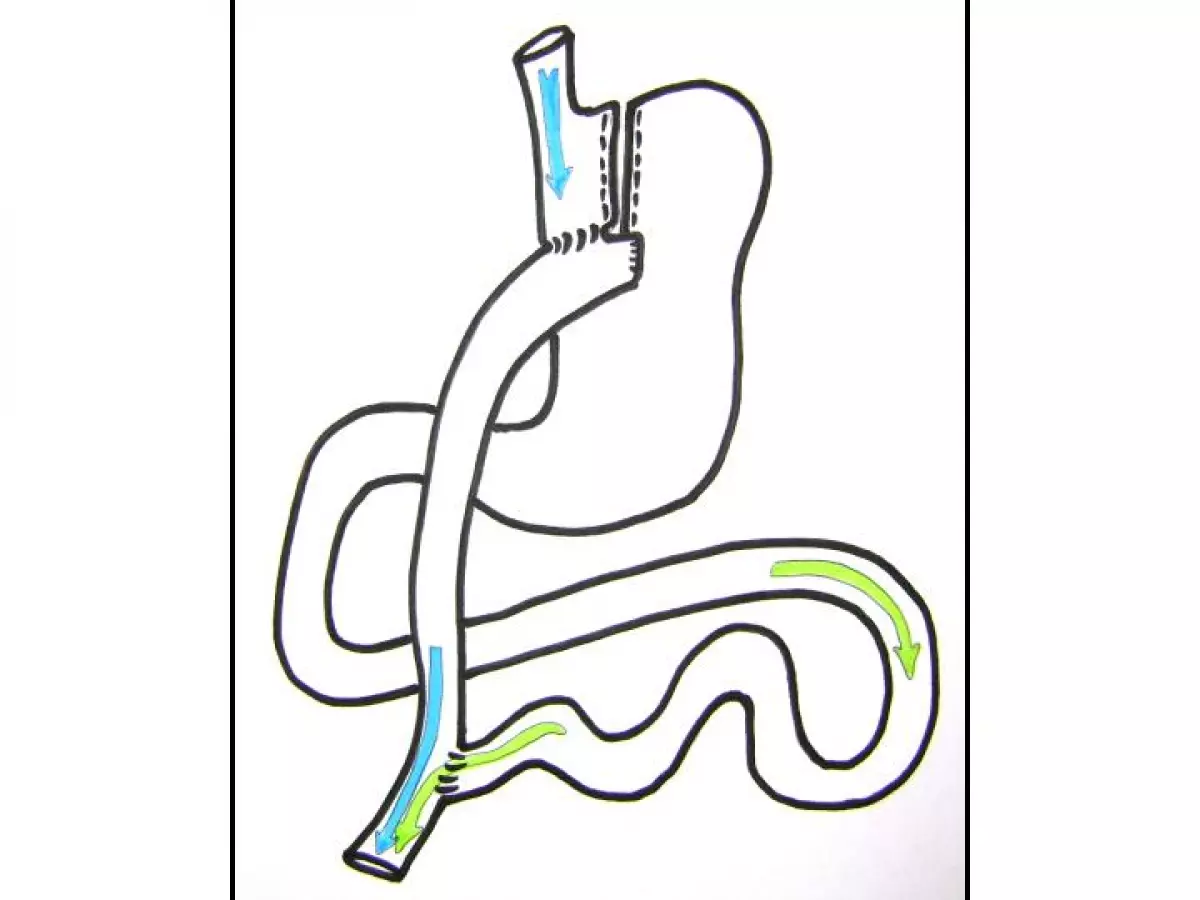 Shéma by pass