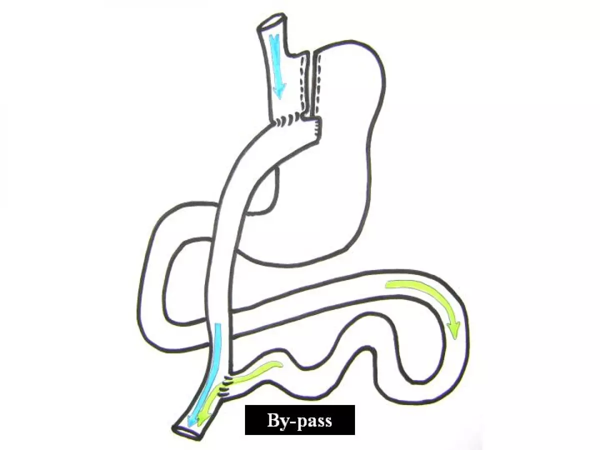 Mini By-Pass: Quelle différence avec le by-pass classique?
