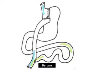 Mini By-Pass: Quelle différence avec le by-pass classique?