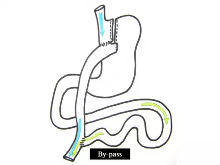 Mini by-pass