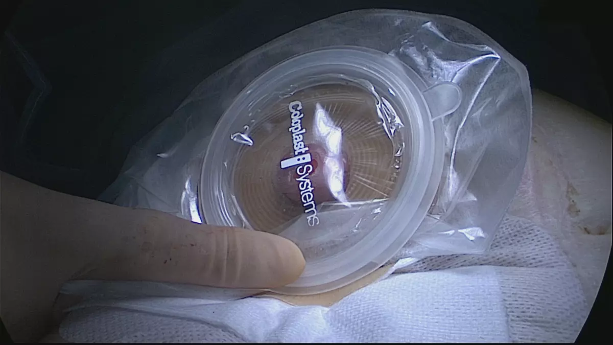 Amputation du rectum