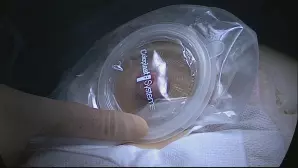 Amputation du rectum