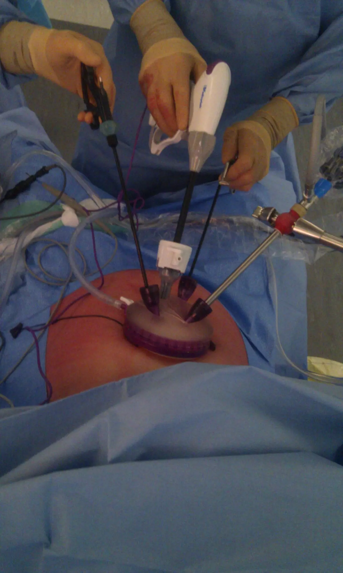 Chirurgie sans cicatrice...visible