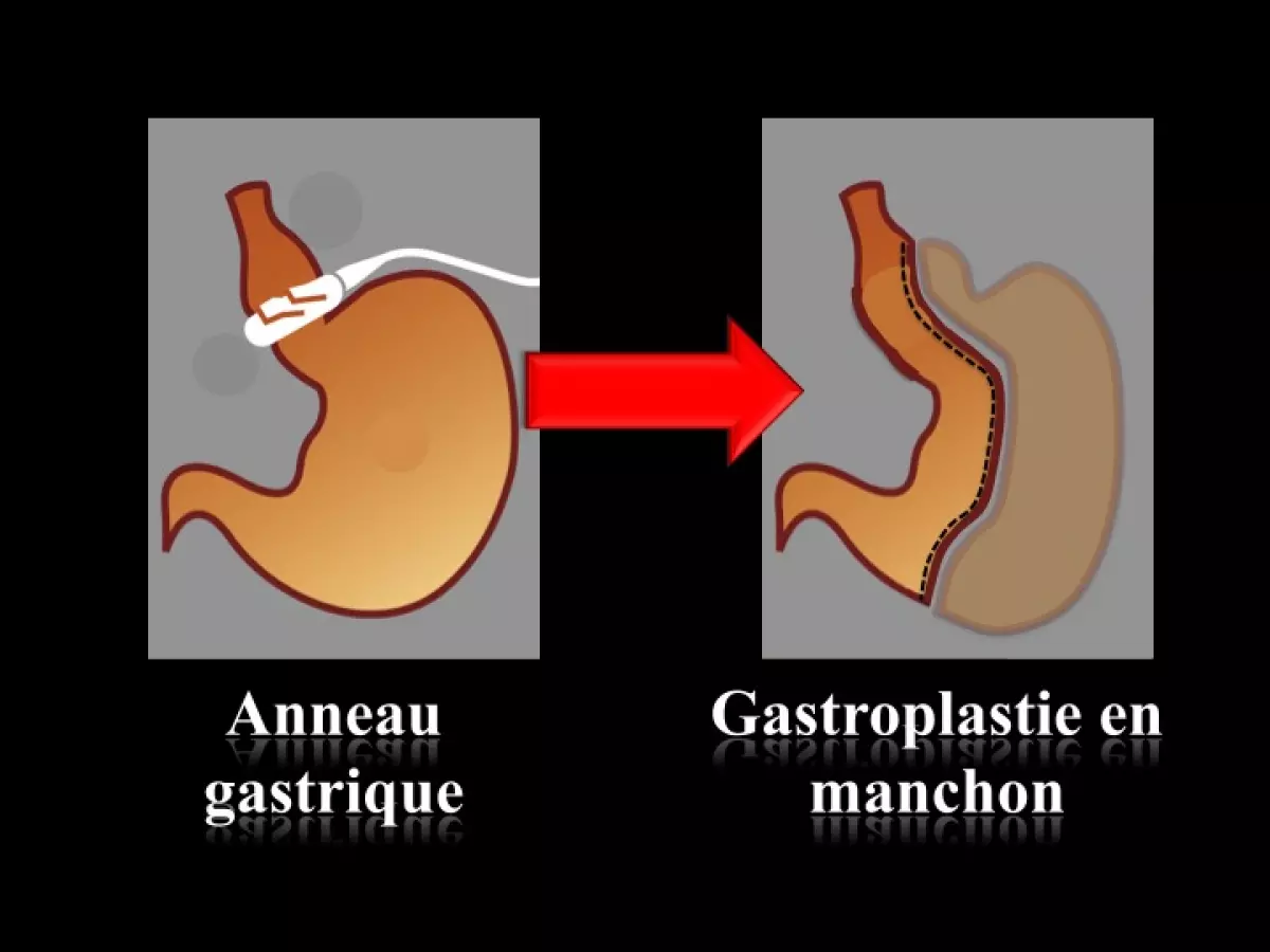 Sleeve gastrectomie