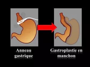 Chirurgie bariatrique : les techniques