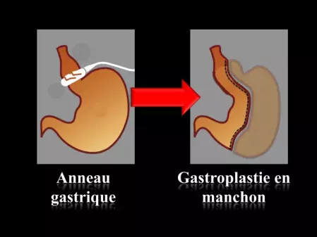 Chirurgie bariatrique : les techniques