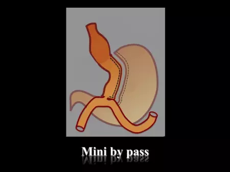 mini by pass