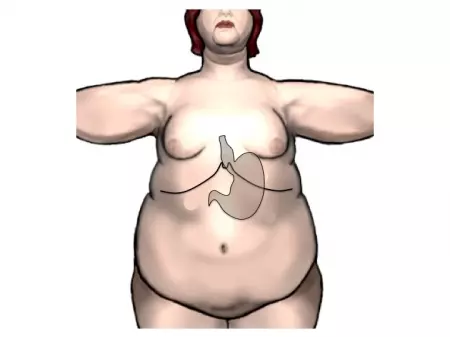 La chirurgie de l'obésité ou chirurgie bariatrique