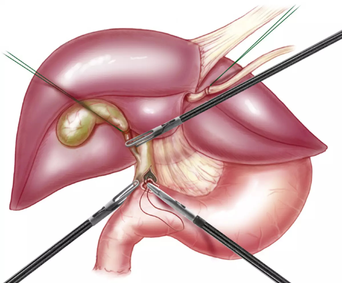 Anastomose bilio-digestive