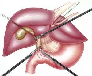 Anastomose bilio-digestive