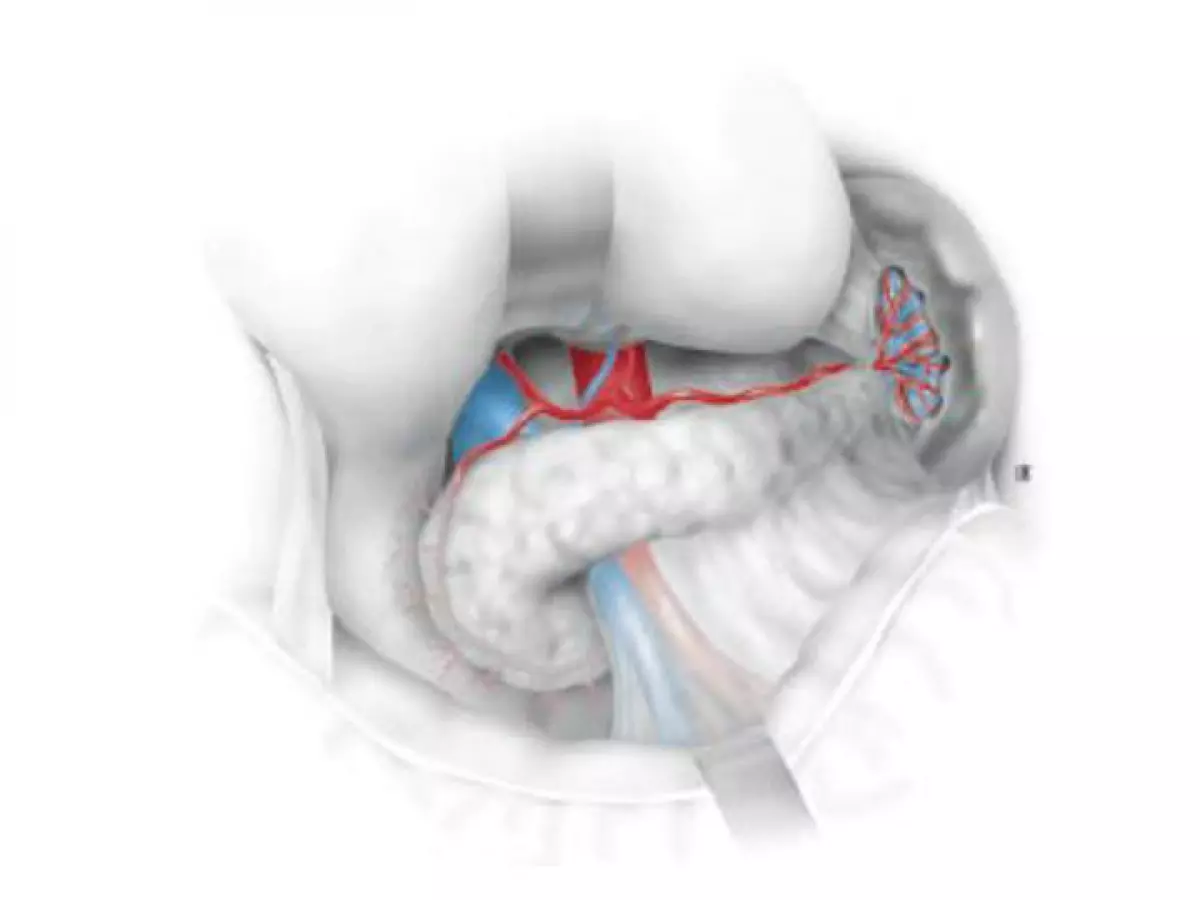 Chirurgie du pancréas et de la rate