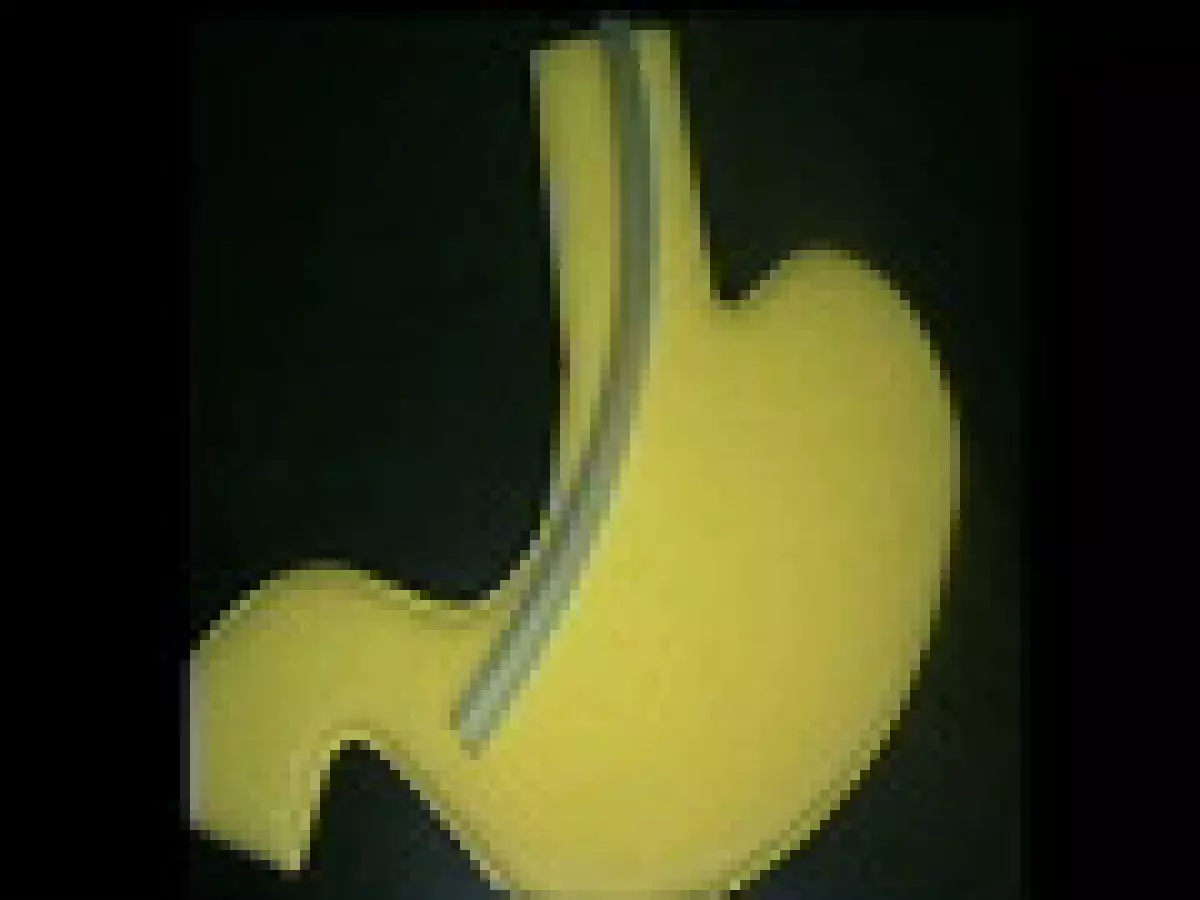 Gastrectomie longitudinale