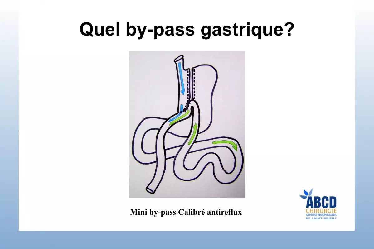 Mini by pass calibré antireflux