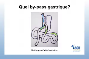 Mini by pass calibré antireflux