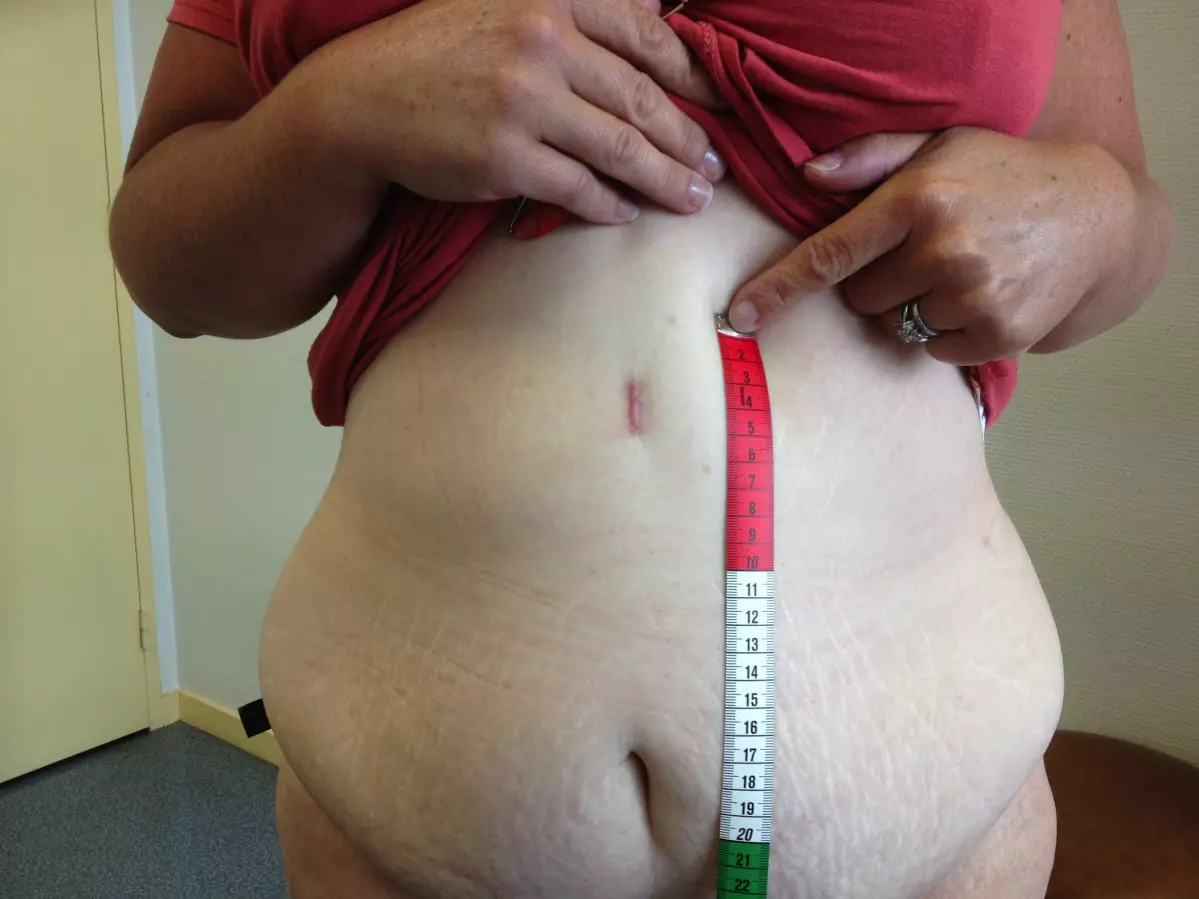 La gastrectomie longitudinale