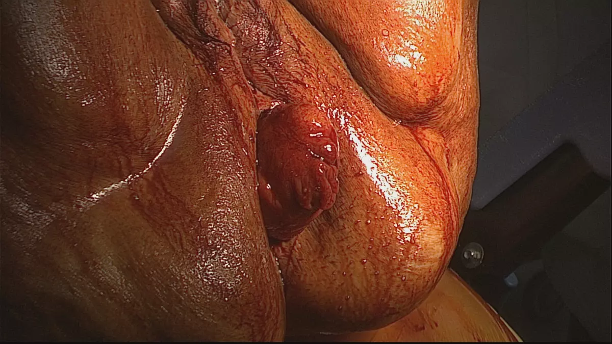 Prolapsus rectal: Quelle opération choisir?