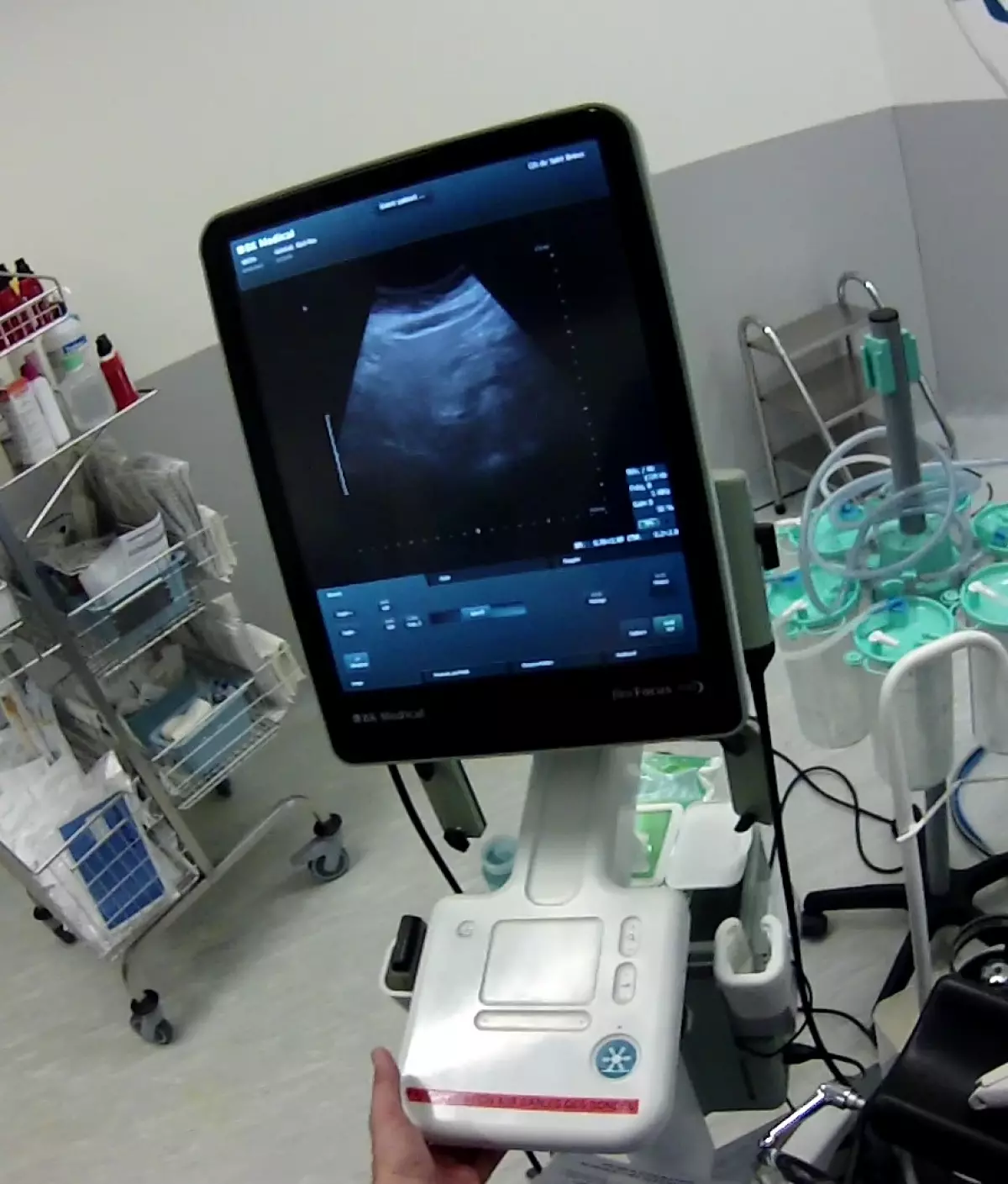 Echographie per-opératoire